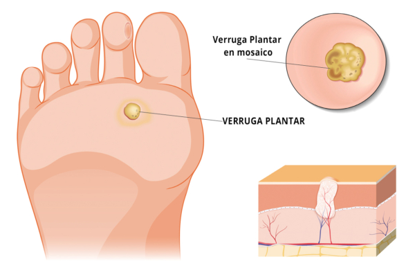 Verrugas Plantares O Papilomas En El Pie Podolog A En Pamplona