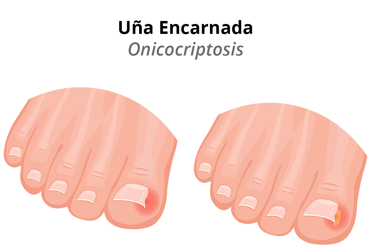 Qué es una uña encarnada onicocriptosis
