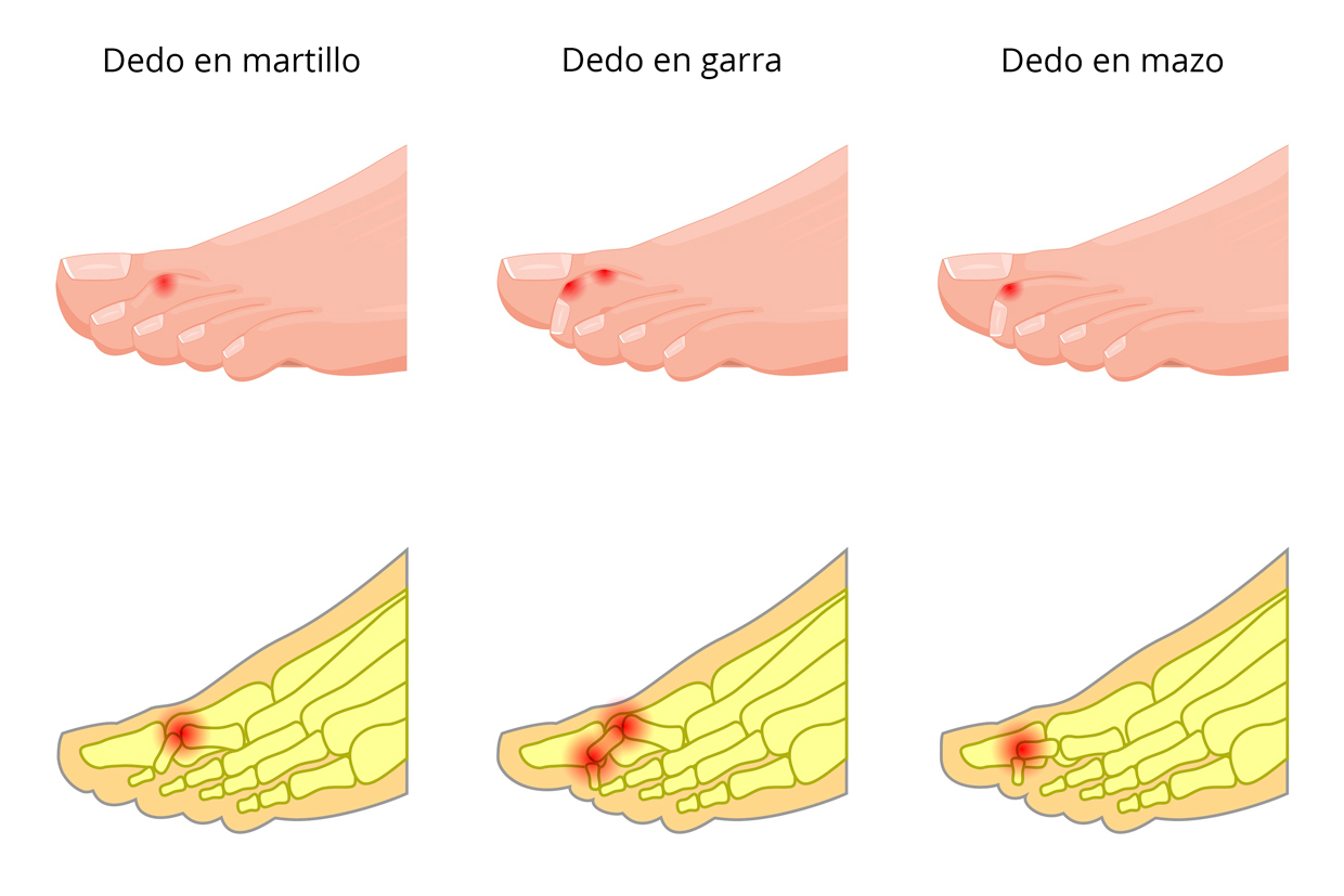 podologo en Pamplona deformidades dedos del pie Clinica Miriam del Villar